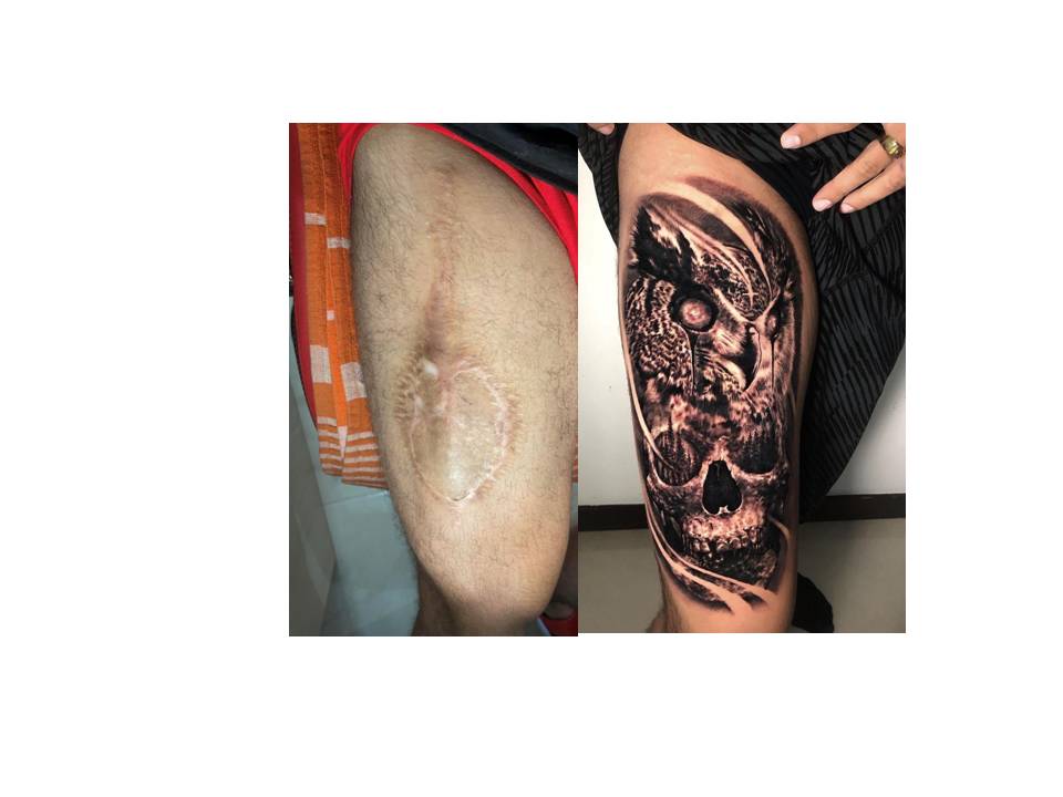 Tatuajes que cubren cicatrices | El Placer de Ser...